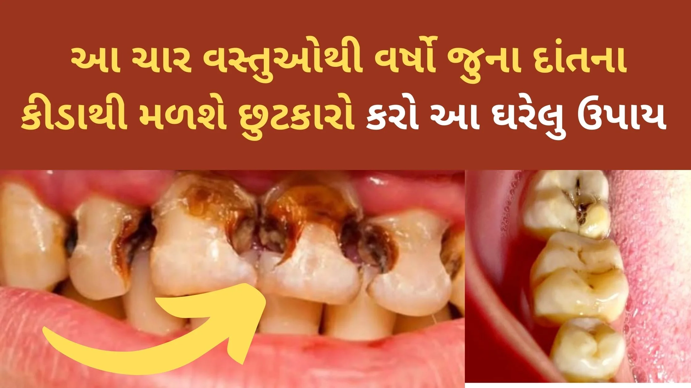 home remedies for tooth