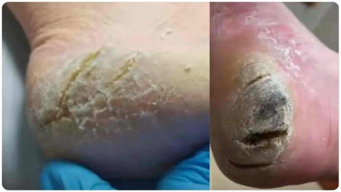 રાત્રે સૂતા પહેલા પગ પર લગાવો આ 3 વસ્તુઓ, પગની એડીઓ થઈ જશે મુલાયમ crack heel repair home remedy in gujarati